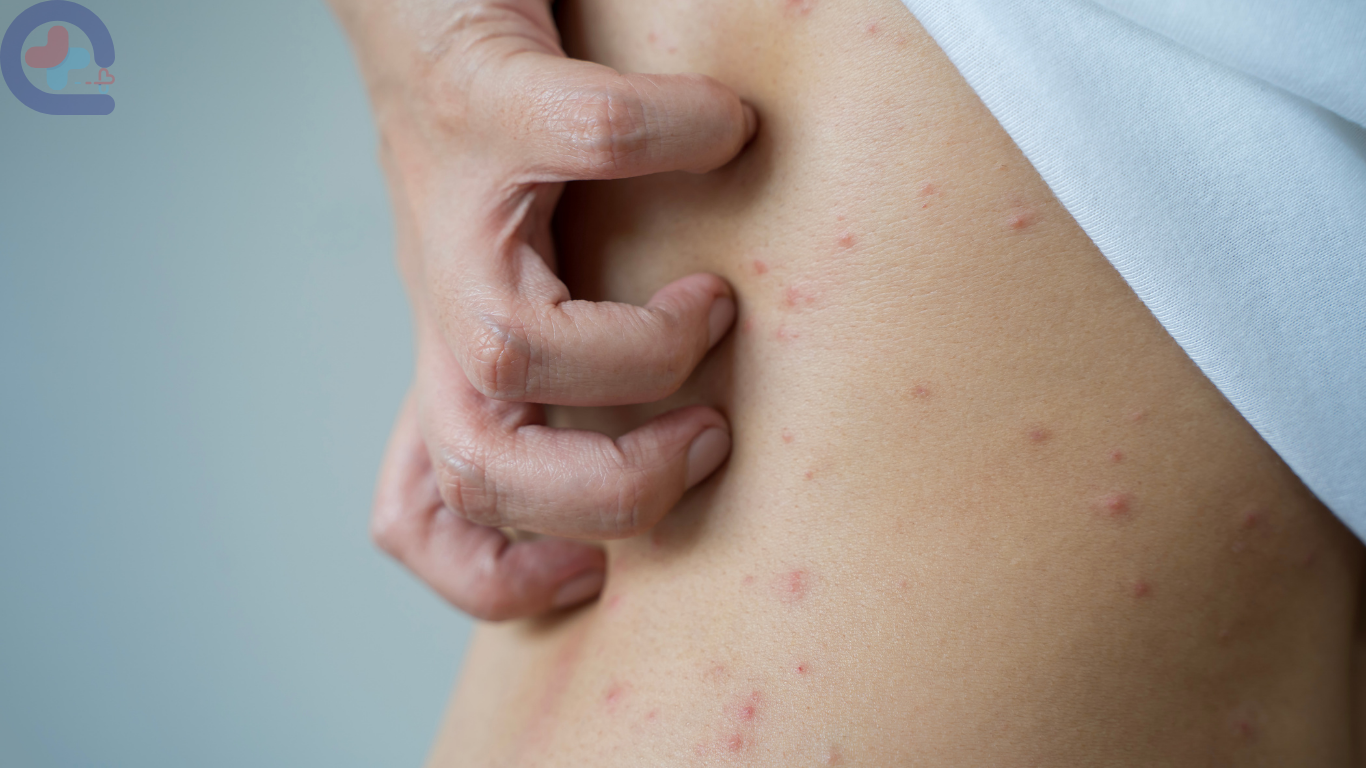 ตุ่มนูน แดง คัน ขึ้นทั่วตัว เป็นอะไรกันแน่